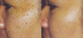 Skin Imperfection Removal Consultation by Superfrecator