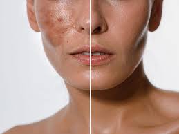 Chemical Peels for ALL Skin Types & Concerns