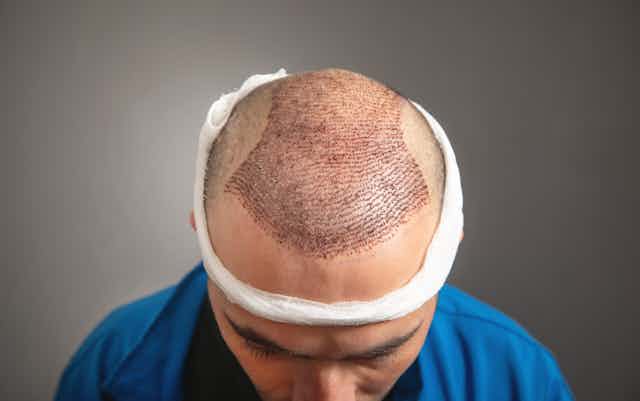 Hair Transplant