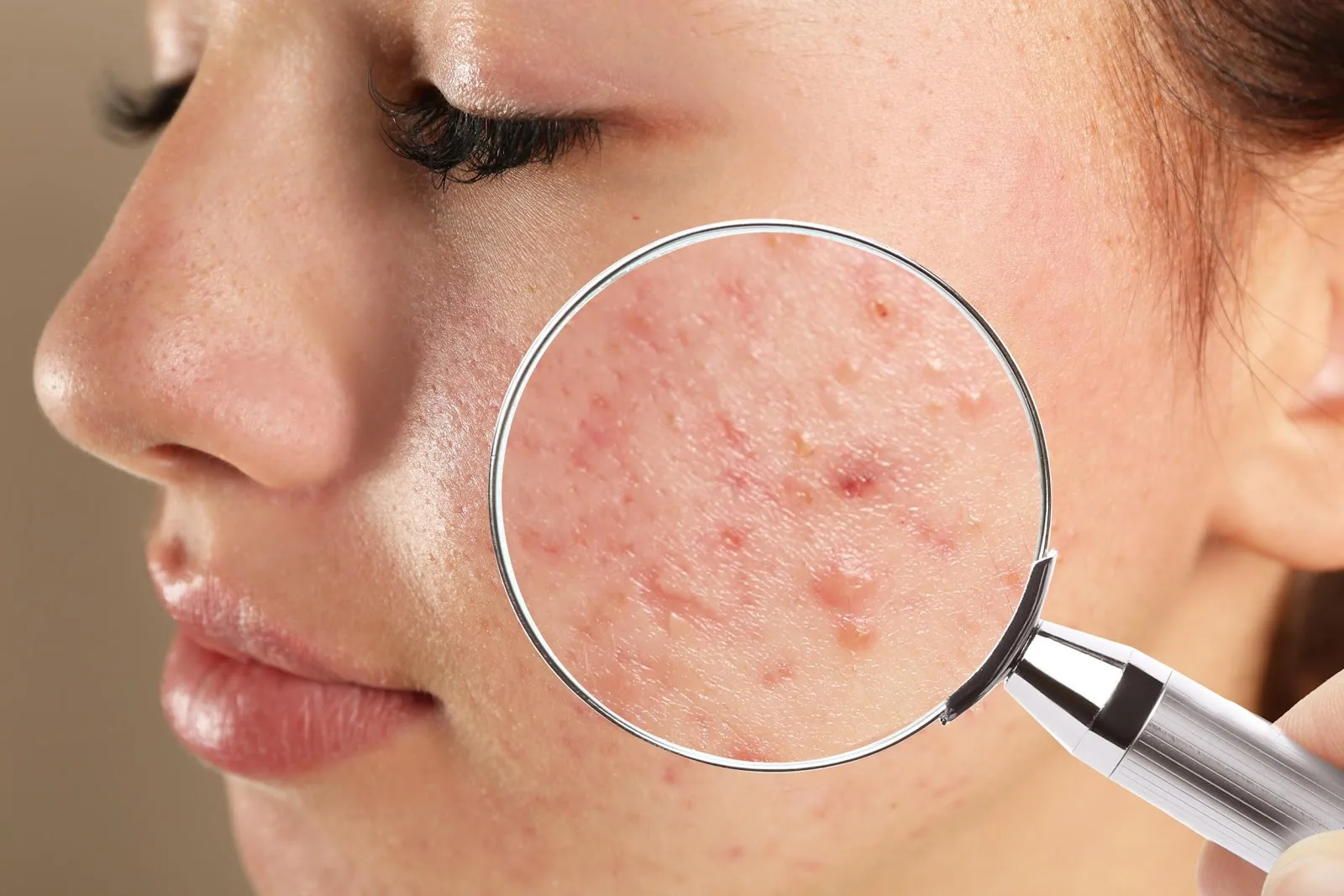 Can Salicylic Acid Peeling Reduce Acne Scar Appearance?