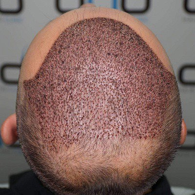 Hair Transplant