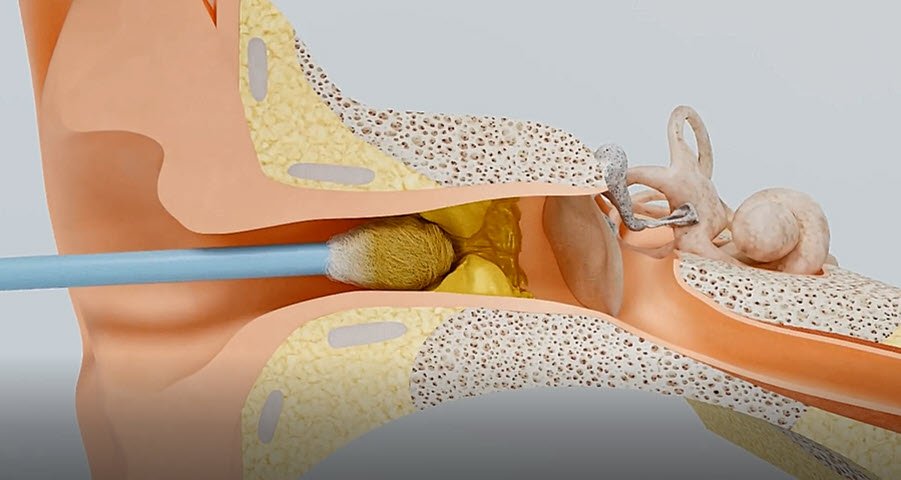 Μπορεί η Μπατονέτα να Οδηγήσει σε Απώλεια Ακοής;
