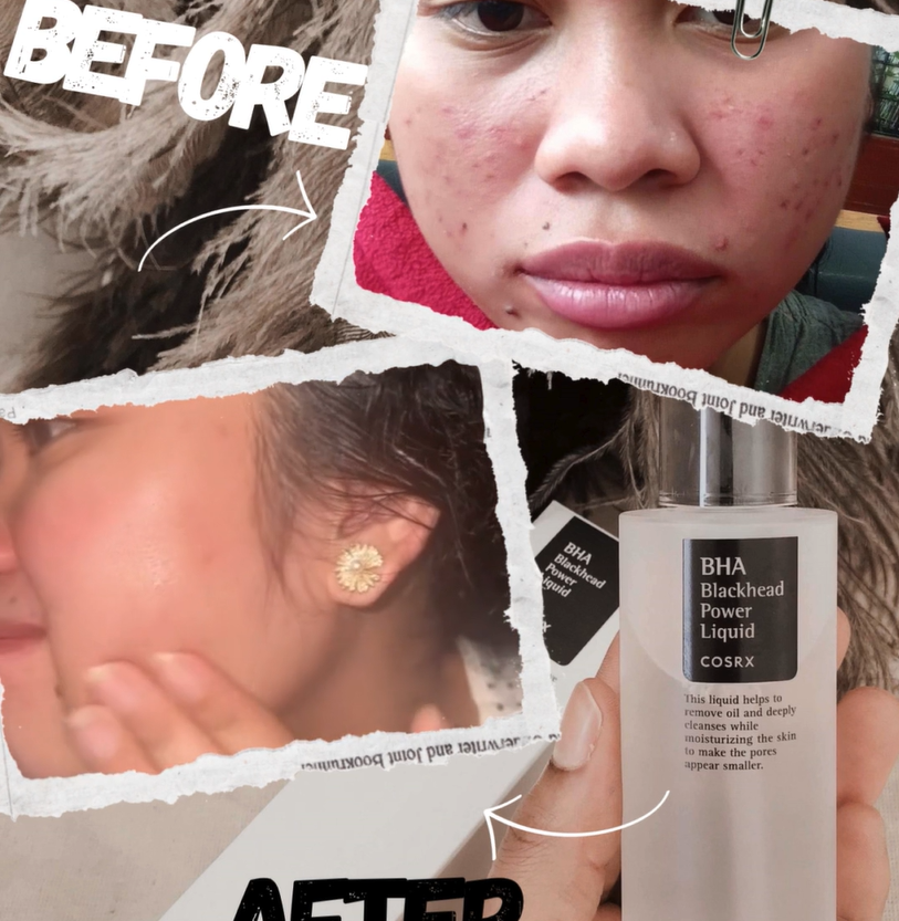 From Breakouts to Balance: My Honest Experience with the COSRX BHA Blackhead Power Liquid
