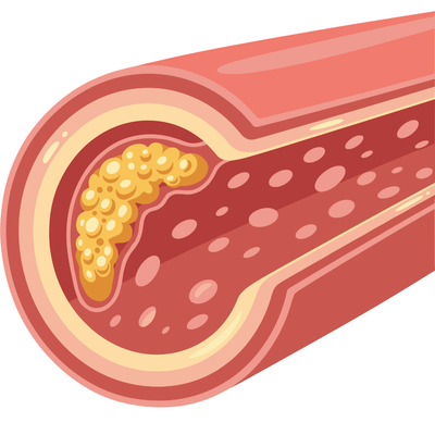Why Your Cholesterol Increases — A Physician Explains Lipids and Heart Risk