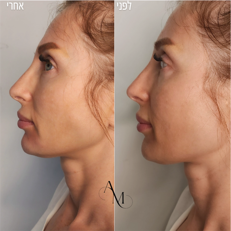 עיצוב קו לסת וסנטר