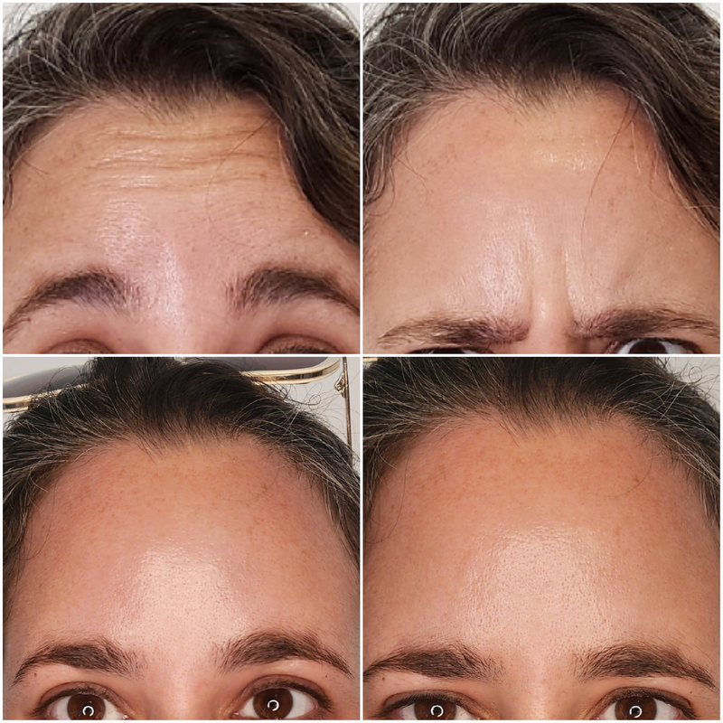 טיפולים בבוטוקס