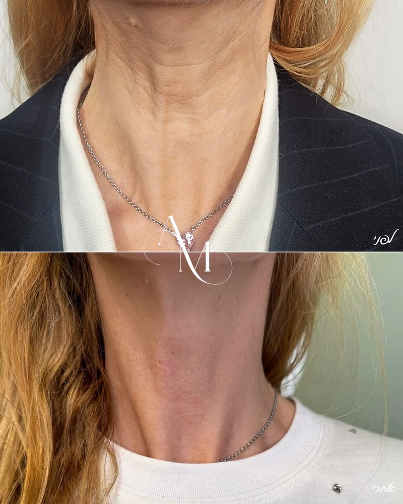 טיפולים לאזור הצוואר