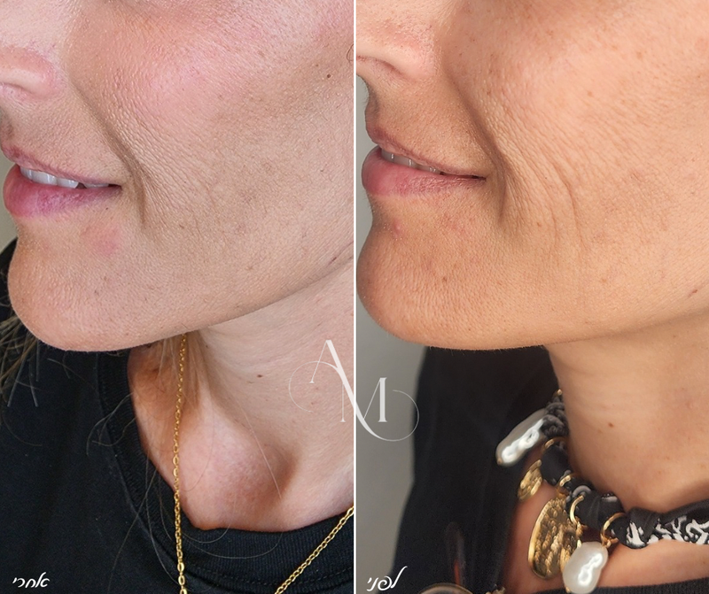 סקין- בוסטר