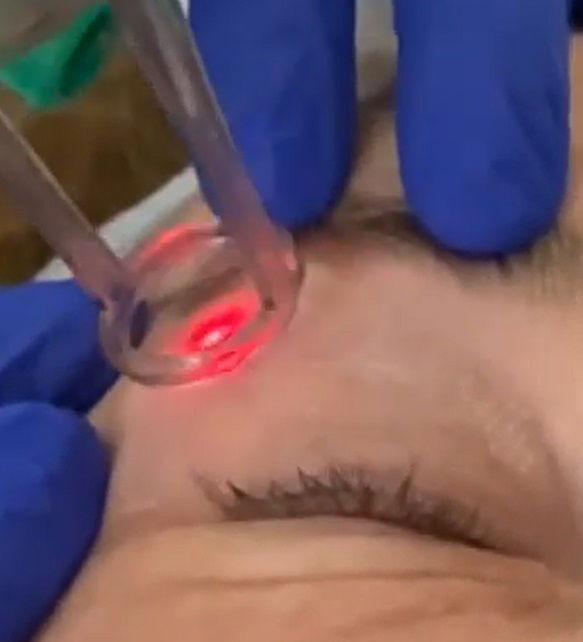 ELIMINACION DE TATUAJES Y CICATRICES