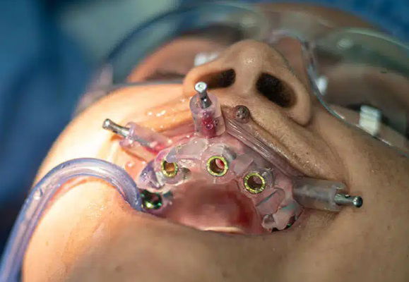 COLOCACION DE IMPLANTES DENTALES INMEDIATOS