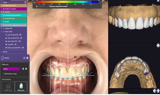 DISEÑO DE SONRISA DIGITAL