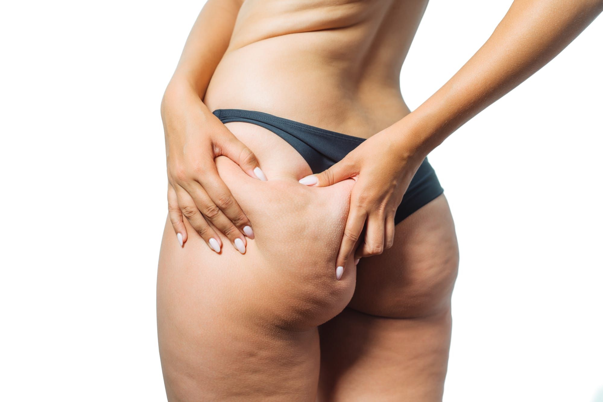 SOS Cellulite: Verità e Rimedi Efficaci