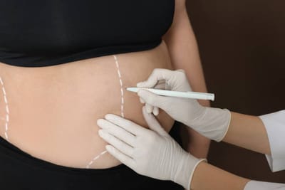 Liposuction in Riyadh: Key Differences Between Traditional and Laser Methods