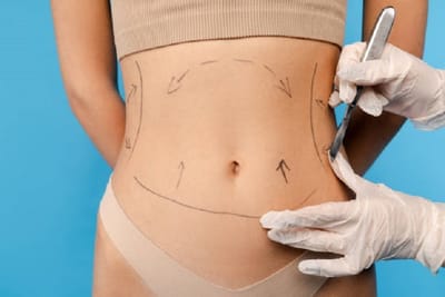 Liposuction in Riyadh: How to Maintain Your New Shape Long-Term