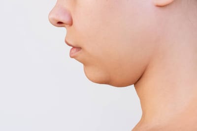 What Type of Anesthesia Is Used for Double Chin Liposuction?