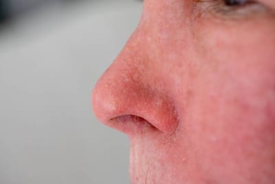 Redness of the Skin Around the Nose: Risks of Untreated Conditions
