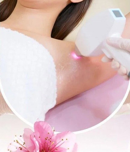 IPL laser treatments