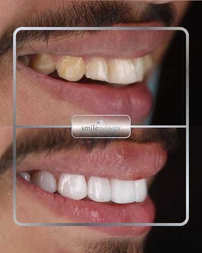 How’s a Hollywood Smile in Lebanon Change Your Look