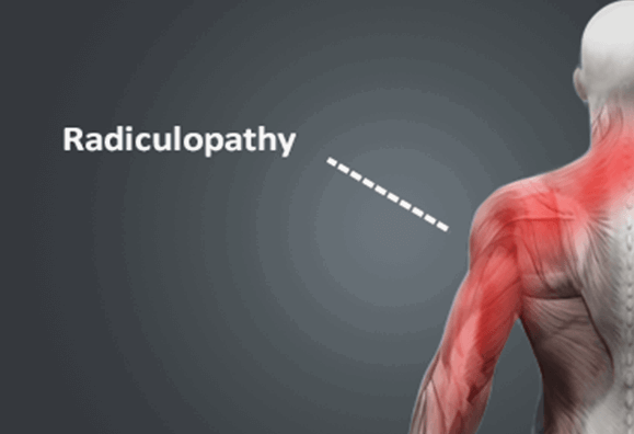 3 Expert Tips for Effective Management of Cervical Radiculopathy