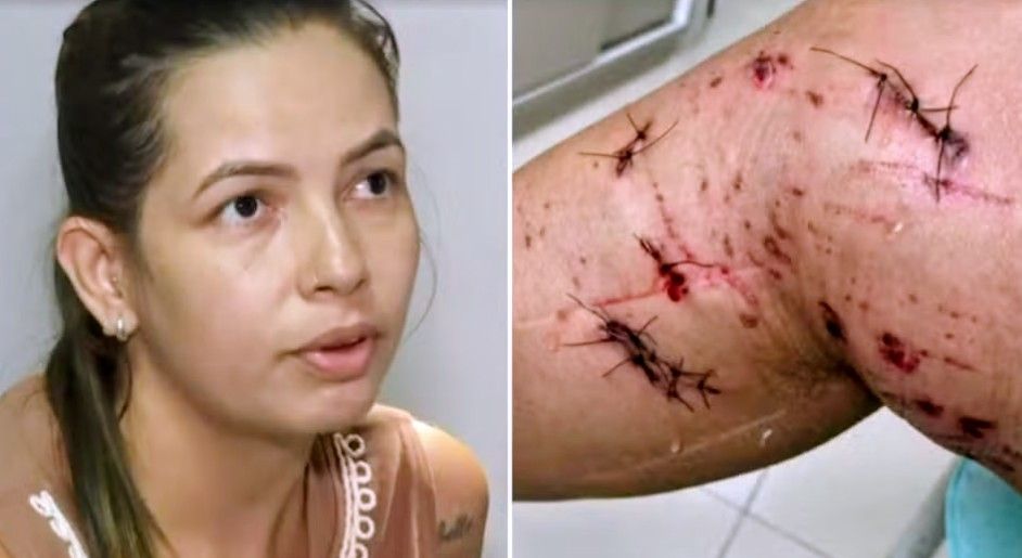 A ATAQUE FEROZ DE UM PITBULL A UMA MULHER EM CONCHAL