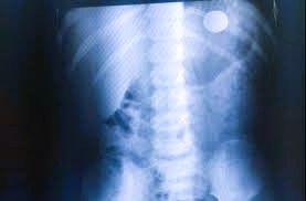 MENINA DE 7 ANOS ENGOLIU QUATRO MOEDAS EM BARRETOS