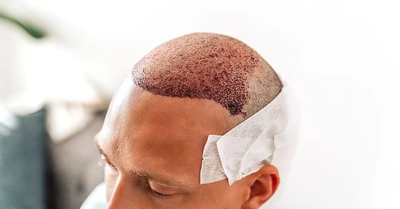 Hair Transplant Benefits: Why It’s Popular Among All Ages