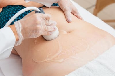 How Does HIFU Work to Reduce Stubborn Fat in Targeted Zones?