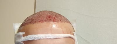 Do Hair Transplants Add Natural Charm to Facial Appearance?