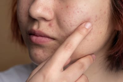 Does Best Pimples Treatment Brighten Dull and Acne-Prone Skin?