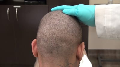 How Does Crown Hair Transplant Achieve Natural Hair Thickness?