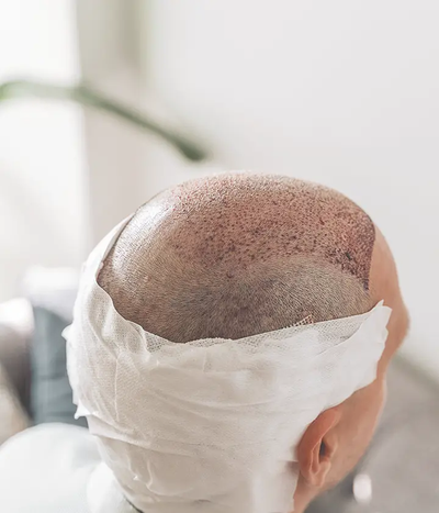 Can Hair Transplant Reduce Trauma to the Donor Site?