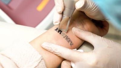 Can Laser Tattoo Removal Help Prevent Scarring After Treatment?