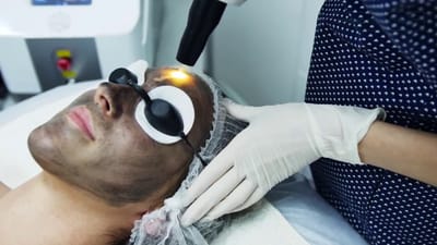 Can Laser Carbon Peel Lighten Hyperpigmentation?