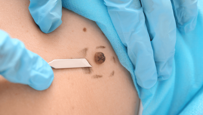 Can Skin Tag Removal Prevent Infections in Tag Areas?