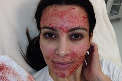 Can Vampire Facial Prevent Premature Skin Aging Signs?