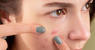 How Can Best Pimples Treatment Improve Skin Texture Safely?