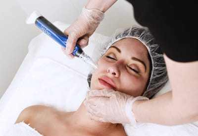 Does Microneedling Help Achieve More Even Skin Tone?