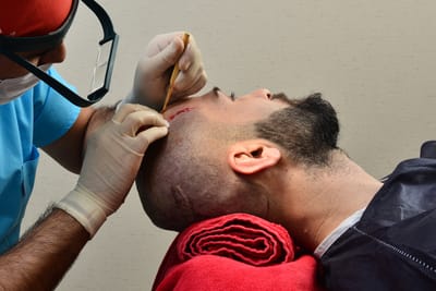 How Does Hair Transplant Treat Pattern Hair Loss Effectively?