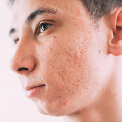 When Should You Visit Acne Scar Laser Treatment Clinic?