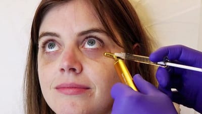 Does Under-Eye Filler Treatment Smooth Under-Eye Bags?
