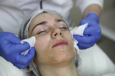 Can Cosmelan Peel Treatment Reduce Acne Marks and Spots?