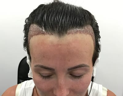 Can Hair Transplant For Women Correct Patchy Hair Thinning Areas?