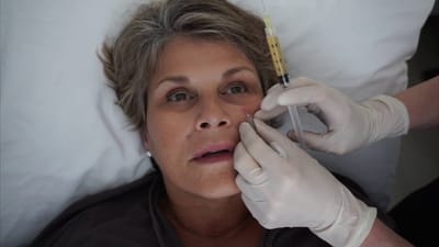 How Does Sculptra Filler Enhance Skin Texture and Quality Now?