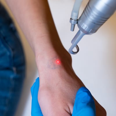 How Does Laser Tattoo Removal Protect Surrounding Skin?
