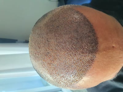 How Does Hair Transplant Reduce Long-Term Hair Expenses?