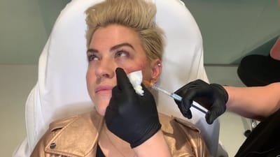What Makes Cheek Fillers Popular in Modern Aesthetics?