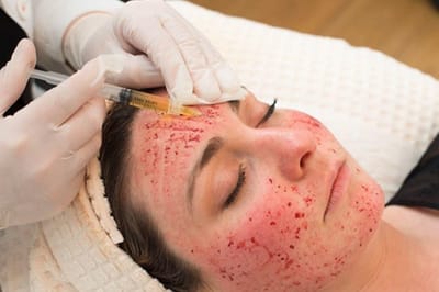 How Long Do Vampire Facial Results Usually Last?