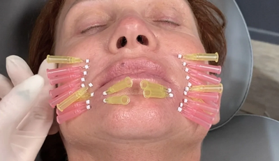 How Do PDO Mono Threads Improve Skin Quality Over Time?