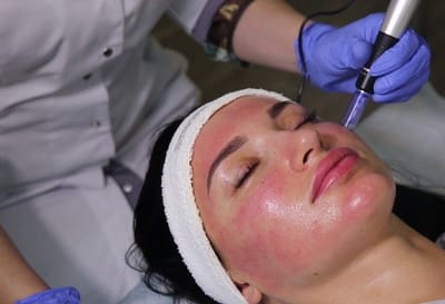 Can a Vampire Facial Fade Acne Marks and Blemishes?