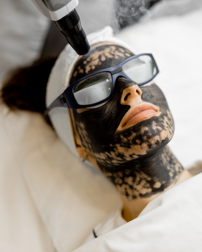 Does Laser Carbon Peel Boost Collagen Production?